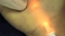 Minimally Invasive Carpal Tunnel Release using the Knife-Light